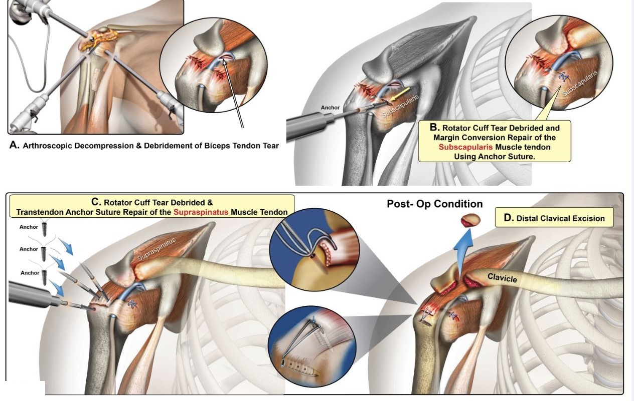 Medical illustration of arthroscopic shoulder surgery: debridement of a biceps tendon tear, anchor-suture repair of the subscapularis and supraspinatus tendons, and distal clavicle excision
